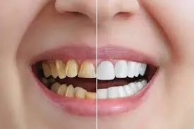 Cosmetic dentistry and smile design