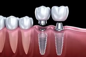 Digitally planned dental implants