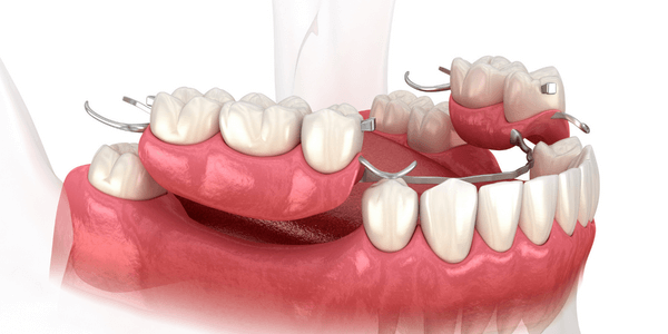 Crown and Bridge Treatment