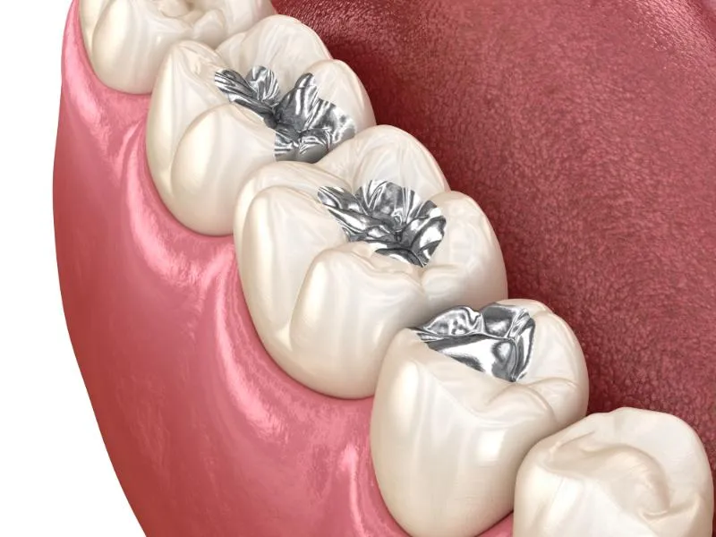 Tooth Coloured Filling