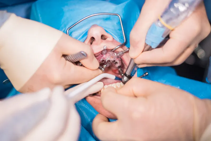 Oral and Maxillo Facial Surgeries
