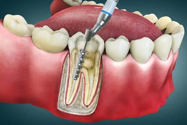 Root Canal Treatment with Rotary Endodontics