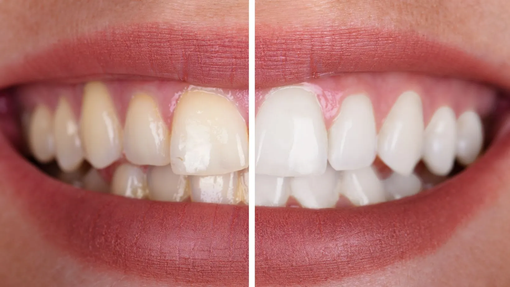 Professional teeth cleaning at Dr. Shameema Nizam's dental clinic