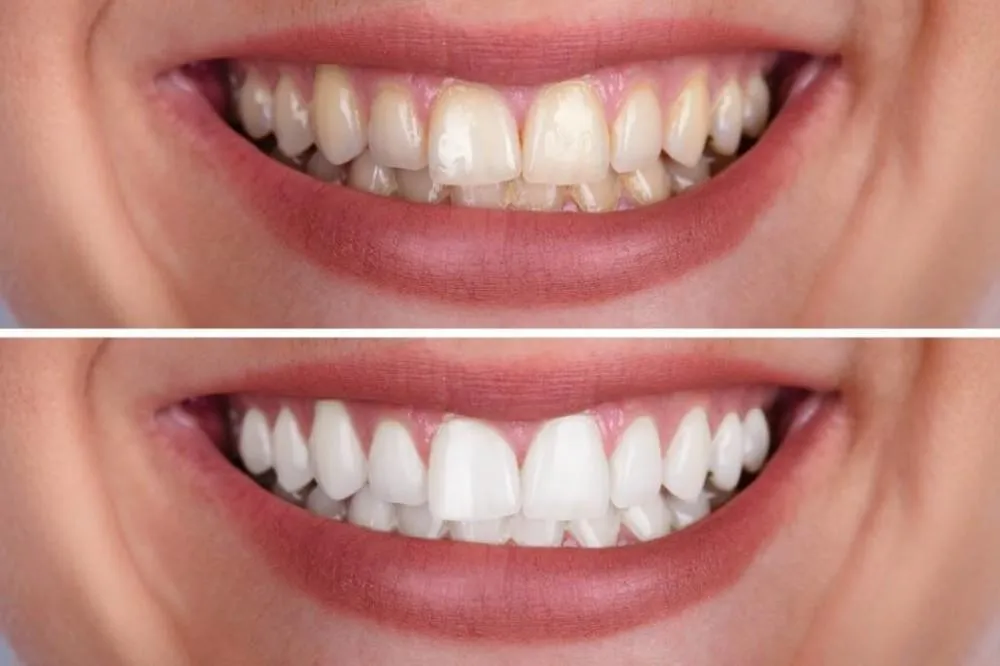In-clinic teeth whitening treatment