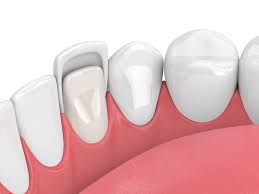 Ceramic Veneers