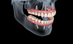 Complete Dentures