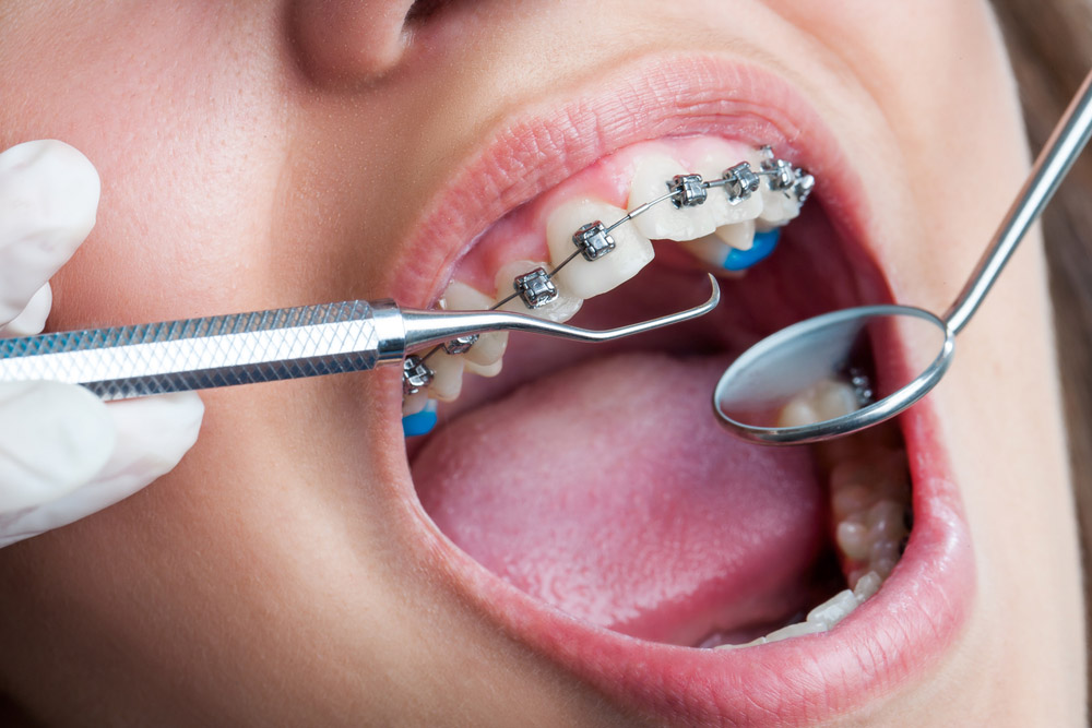 Fixed Orthodontic Treatment