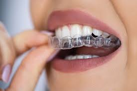 Invisible Aligners and Braces