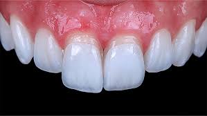 Luminers (No Preparation Veneers)