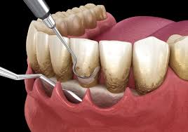 Periodontic Treatment