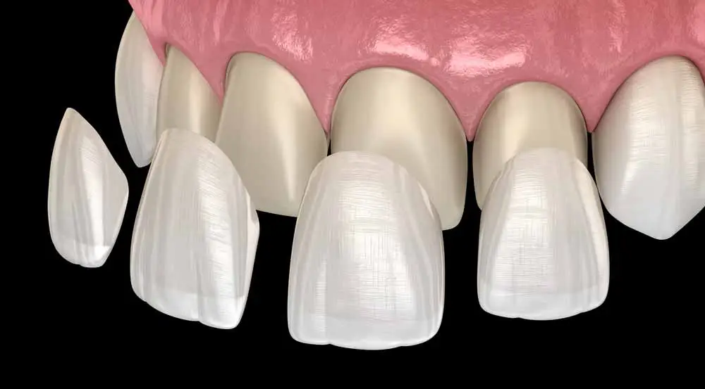 Custom porcelain veneers and crowns